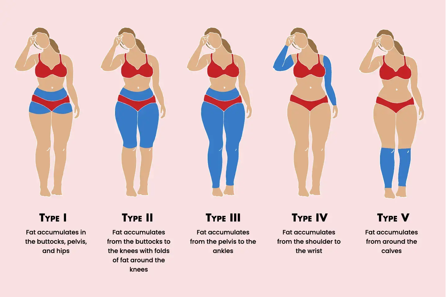 Types of Lipedema - Lipedema Canada